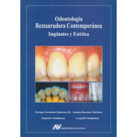 Odontología restauradora contemporánea: Implantes y estética