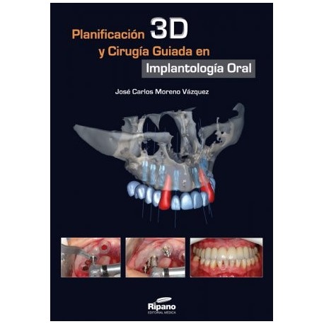 Planificación 3D y Cirugía Guiada en Implantología Oral