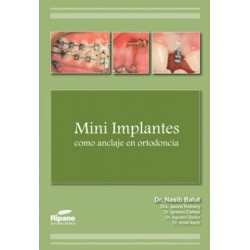 Mini implantes como Anclaje en Ortodoncia