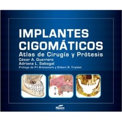 Implantes Cigomáticos Atlas de Cirugía y Prótesis