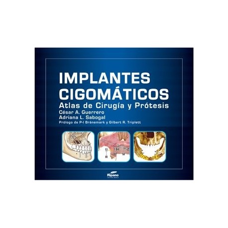 Implantes Cigomáticos Atlas de Cirugía y Prótesis